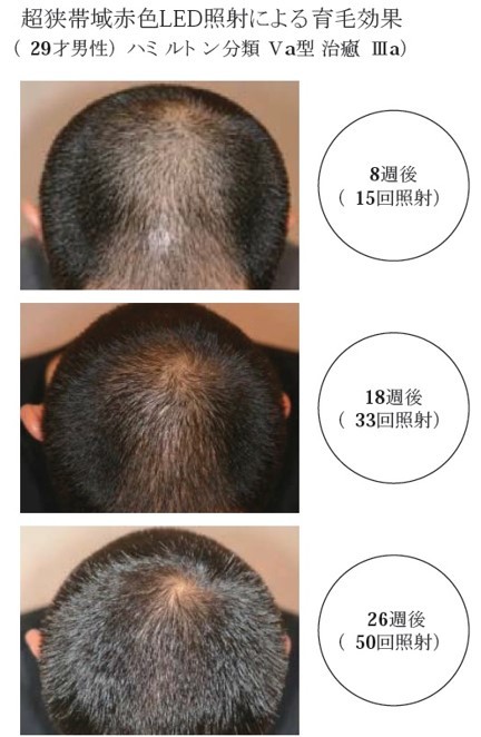 超狭帯域赤色LED照射によるAGA毛髪再生臨床実験の外観